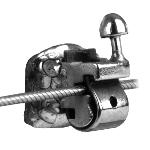 Feste Zahnspange mit Speedbrackets verursachen kaum Reibung.